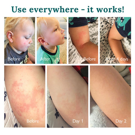 Baby Lotion / Rash Cream | Diaper Rash Cream |Gentle Touch Cream |baby and child eczema cream