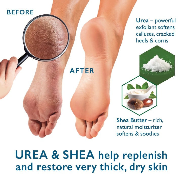 Urea Cream | Callus and Cracked Heel Cream with 40% Urea